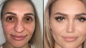 جراحة التجميل للمشاهير في تركيا: الاتجاهات والمخاطر وأفضل الجراحين - Lerra  Clinic - عمليات التجميل في تركيا