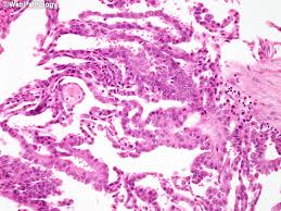 Webpathology Com A Collection Of Surgical Pathology Images