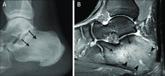 Image result for Osteomyelitis XRay