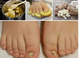 как вылечить грибок ногтя на ноге в домашних условиях Gribok Nogtej Na Nogah Prichiny Simptomy I Sposoby Lecheniya Poleznye Sovety Hozyajkam Nogti Na Nogah Zdorove Poleznye Recepty