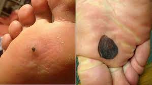 U nekoliko slučajeva, međutim, to se može dogoditi i zbog poremećaja krvi ili terapije lijekovima razrjeđivačima krvi. Tamne Mrlje Na Tabanima Vrste Uzroci Nastanka I Nacini Lecenja