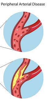 Ted Stockings Compression Socks Vs Ted Hose Prevent Dvt