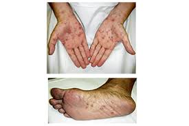 Image result for syphilis symptoms