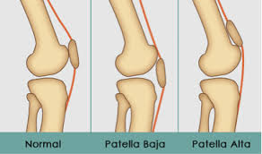 Custom wheels can really spice up the appearance of a car, truck or sport utility vehicle. Resolve Your Knee Pain By Addressing Its Alignment Msk Neurology
