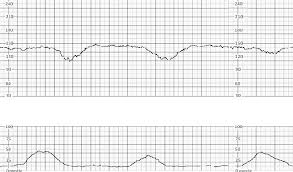 Image result for Late Deceleration