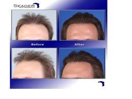 Dr Cam Simmons 11 Months After 2nd Ht Of 3178 Grafts A Total Of 5680 Grafts Were Transp Hair Transplant Before And After Hair Transplant Straight Hairstyles