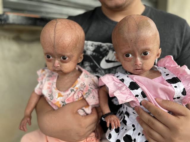Irmãs são diagnosticadas com síndrome rara da velhice precoce em RR e esse  pode ser o primeiro caso em gêmeas do mundo | G1