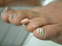 As the cancer grows, the pain will be there all the time, and get worse with activity. When A Patient Has An Unusual Growth On A Toe Podiatry Today