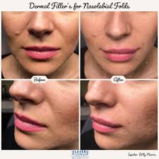 Hyaluronic acid gel (24 mg/ml) with 0.3% lidocaine device: Juvederm Dermal Filler Before And Bill The Injector At The Laser Lounge Spa Facebook