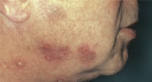 A glossary of terms used to describe symptoms, complications, tests. Die Vielen Gesichter Des L Erythematodes