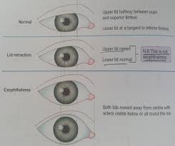 Lid lag phenomenon revealing myotonia congenita lid lag phenomenon revealing myotonia congenita: Quick Med On Twitter Thyrotoxicosis The Clinical Manifestation Of Excess Thyroid Hormone Action Due To Inappropriately High Circulating Thyroid Hormone Associated With Four Eye Signs 1 Lid Retraction And Lid Lag 2 Exophthalmos 3 Ophthalmoplegia