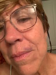 Diving Accident in Grand Cayman Results in a Bruise