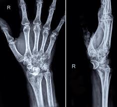 Image result for Lunate Dislocation