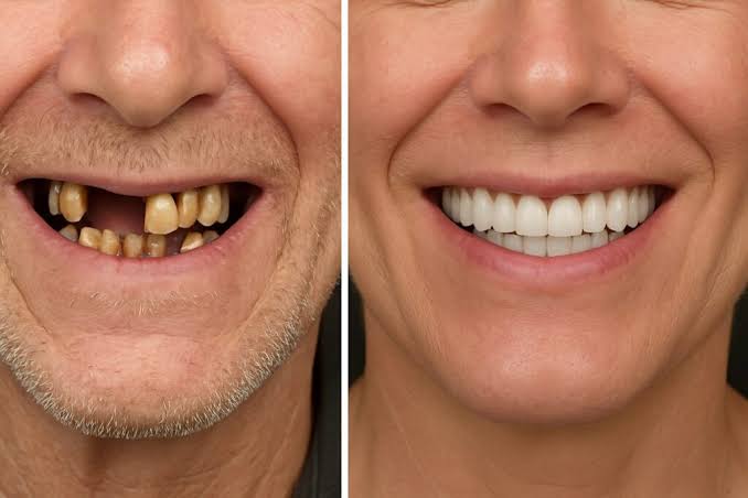 Full Arch Restoration Before & After, AI generated