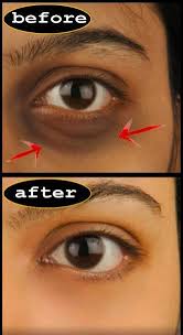 How To Get Rid Of Dark Circles Darkcircleshowtogetridof Darkcirclesundertheeyes Darkcirclesremedi Dark Circle Remedies Dark Circles Under Eyes Spots On Face