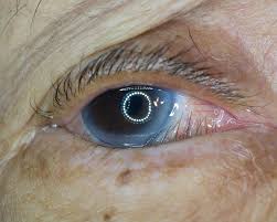 Image result for Entropion