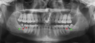 Setelah prosedur cabut gigi, pasien dapat merasakan sejumlah efek samping, seperti nyeri, wajah dan mulut menjadi bengkak. Klinik Pergigian I Pro Dental Surgery Cabutan Gigi Geraham Bongsu Wisdom Tooth Removal