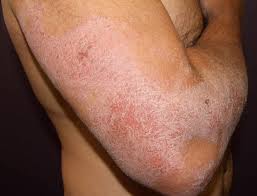 Image result for Atopic eczema atopic dermatitis