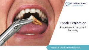 Image result for Tooth Extraction