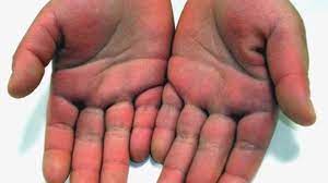 Rash 22 Common Skin Rashes Pictures Causes And Treatment