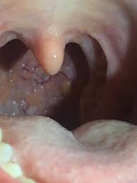 Many are just risk factors that compromise the state of your oral health, encouraging the development of precancerous cells. Hpv Throat Cancer Reddit