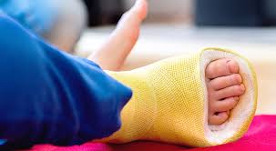 Document any signs of pain. Kid S Broken Arm Or Leg What To Do Norton Children S Louisville Ky