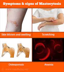 Mastocytosis - Types, Causes, Symptoms, Diagnosis, Treatment And Prognosis