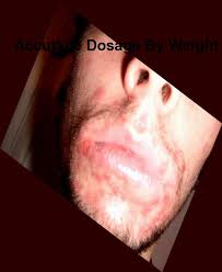 accutane dosage