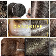 Dandruff can show up in a variety of ways, including: Best Dandruff Treatment In Homeopathy Top Medicines Shampoo Oil Homeopathy Remedies Online