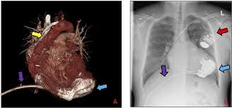 The pump is placed in the upper part of the abdomen. Implantable Left Ventricular Assist Device Indications Eligibility And Current Outcomes Heart