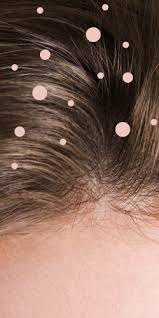 However, severe dandruff can cause a person to scratch their scalp so hard that they injure it. What Causes Dandruff The Truth Behind 9 Common Dandruff Myths Self