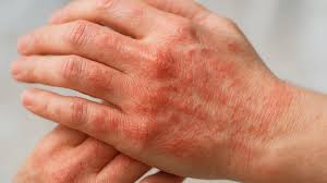 Image result for Hand Dermatitis