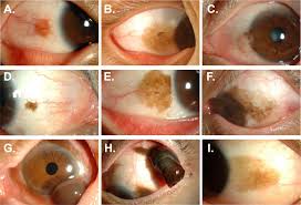 Image result for melanosis sclera