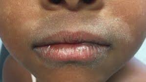 Image result for ekzema face