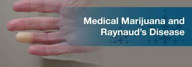 Medical Marijuana For Raynaud S Disease Marijuana Doctors