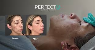 Image result for acne face