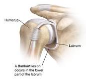 Image result for icd 10 code for bankart tear