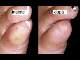 O alta metoda de tratament consta in folosirea frunzei de praz care se pune la macerat in otet timp de 24 de ore. Bataturile De Pe Degetele De La Picioare SoluÈ›ia FinalÄƒ Youtube