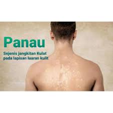 Kurap (dermatophytosis) terdiri dari beberapa jenis penyakit kulit yang disebabkan oleh ‎jangkitan kulat. Krim Merawat Panau Kulat Kurap Shopee Malaysia