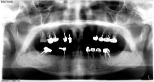 3D Dental Implant Center