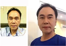 Căng da mặt bằng chỉ vàng 24K uy tín tại Hà Nội