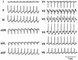 Psvt is the most common arrhythmia in infants, children, and women who are pregnant. Paroxysmal Supraventricular Tachycardia Thoracic Key