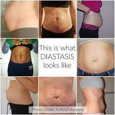 What does diastasis recti feel like. Pin On Evelyn Grace