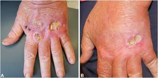 Image result for Pyoderma Gangrenosum