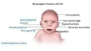 Frequently Asked Questions Fetal Alcohol Fetal Alcohol Syndrome Spectrum Disorder