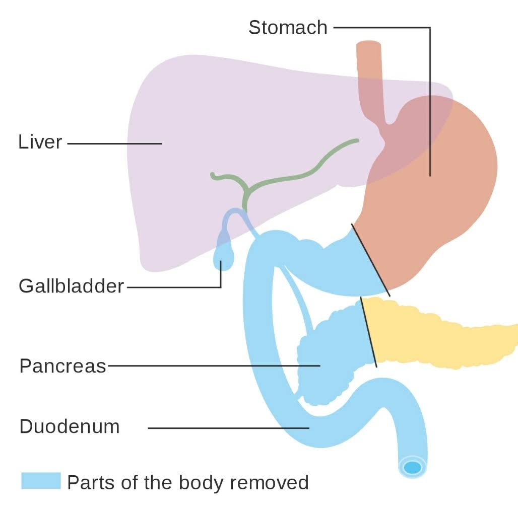 Pancreas cancer surgery