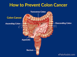 Colorectal cancer might not cause symptoms right away. Colon Cancer Or Cancer Of The Colon Survival Rate Recurrence Prevention Coping