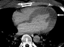 Image result for Cardiac Contusion