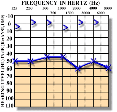 If a conductive hearing loss occurs in conjunction with a sensorineural hearing loss, it is referred to as a mixed hearing loss. Conductive Hearing Loss