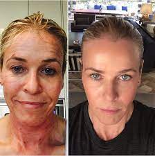 Check spelling or type a new query. Chelsea Handler Celebs Who Celebrate The Beauty In Their Imperfections Livingly